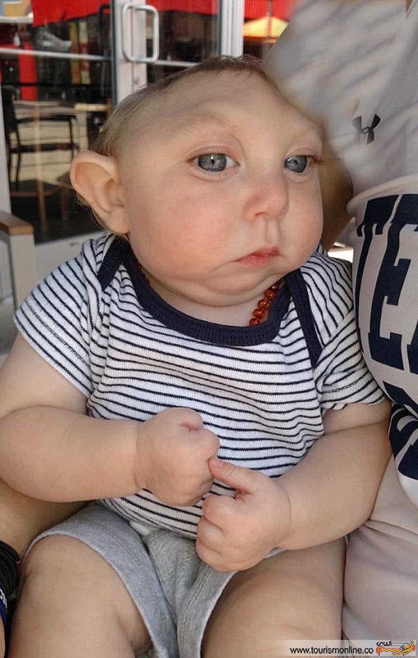 کودکی با جمجمه نصفه