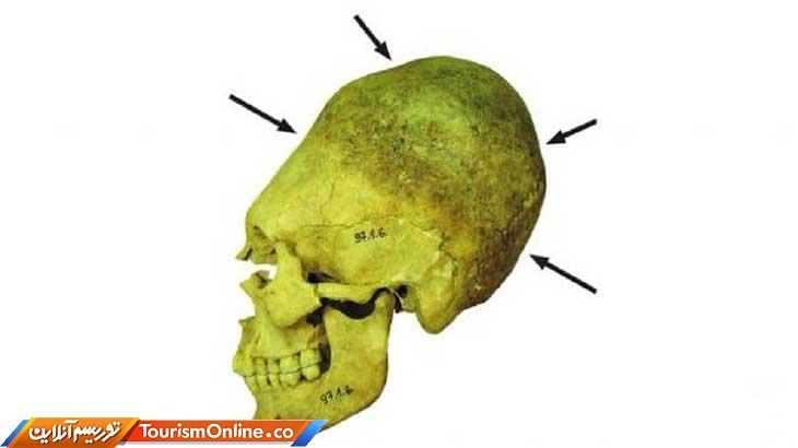 جراحی جمجمه امچراطوری روم