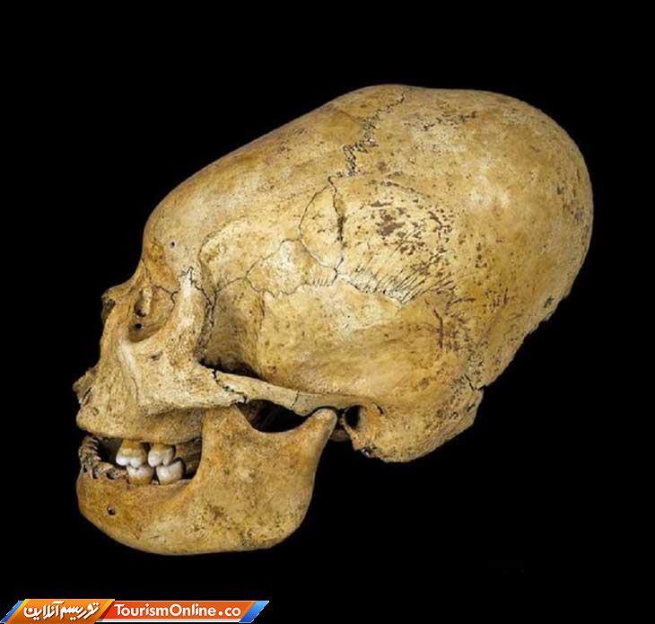 جراحی جمجمه امچراطوری روم