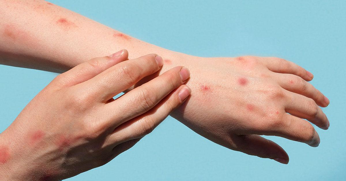 آبله میمونی