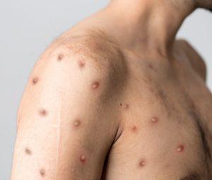  آبله میمونی 