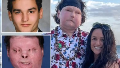 پیوند موفق صورت