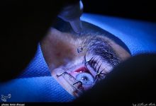 عمل تغییر رنگ چشم