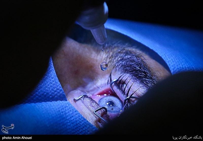 عمل تغییر رنگ چشم