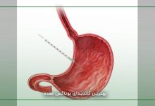 بوتاکس معده