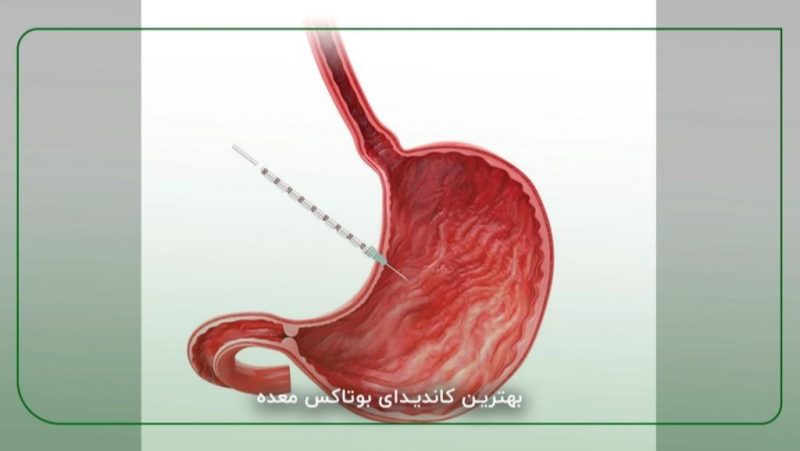 بوتاکس معده